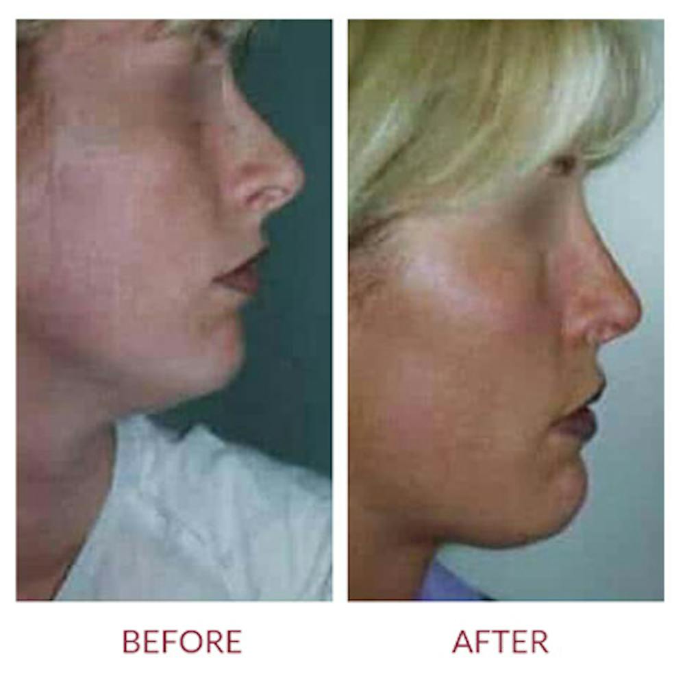 Rhinoplasty Before & After Gallery - Patient 26873278 - Image 1