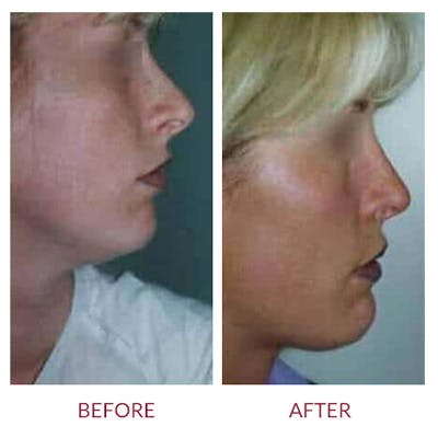 Rhinoplasty Before & After Gallery - Patient 26873278 - Image 1