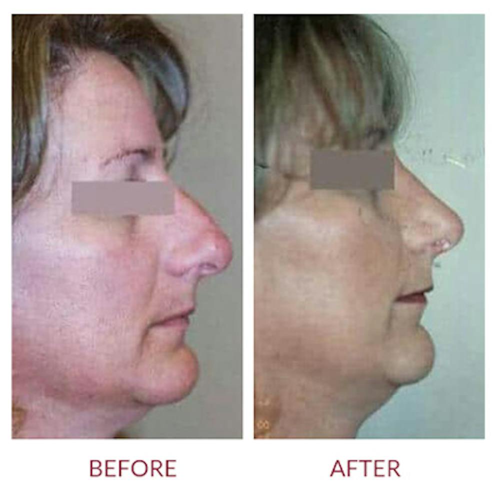Rhinoplasty Before & After Gallery - Patient 26873277 - Image 1