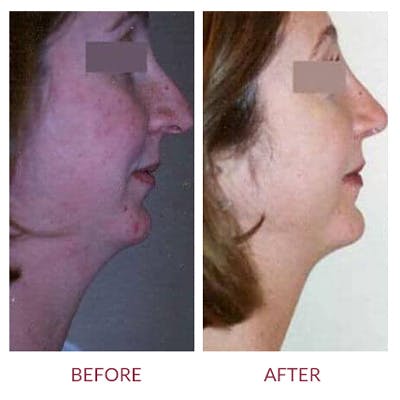 Rhinoplasty Before & After Gallery - Patient 26873276 - Image 1