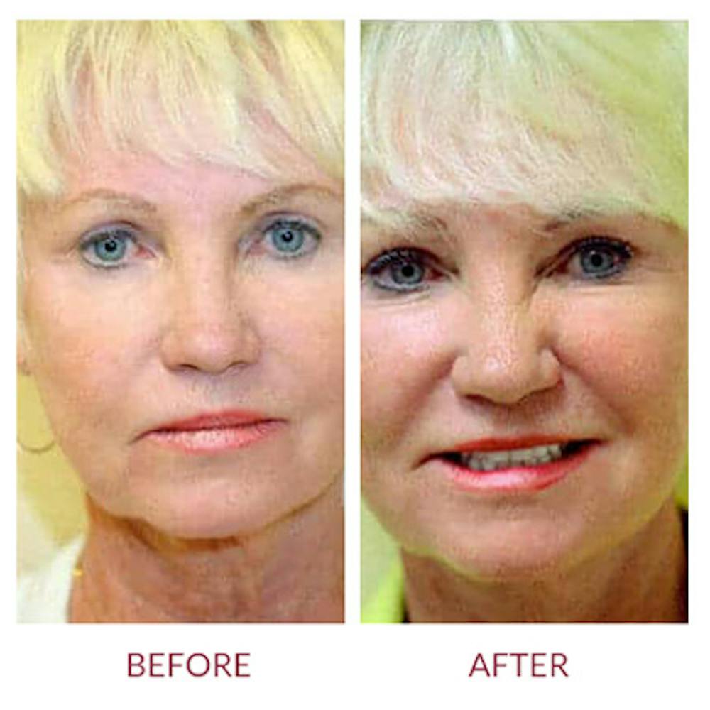 Ultherapy Before & After Gallery - Patient 26874674 - Image 3