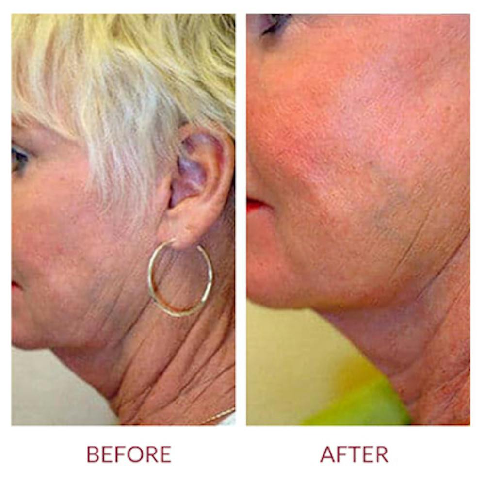 Ultherapy Before & After Gallery - Patient 26874674 - Image 2