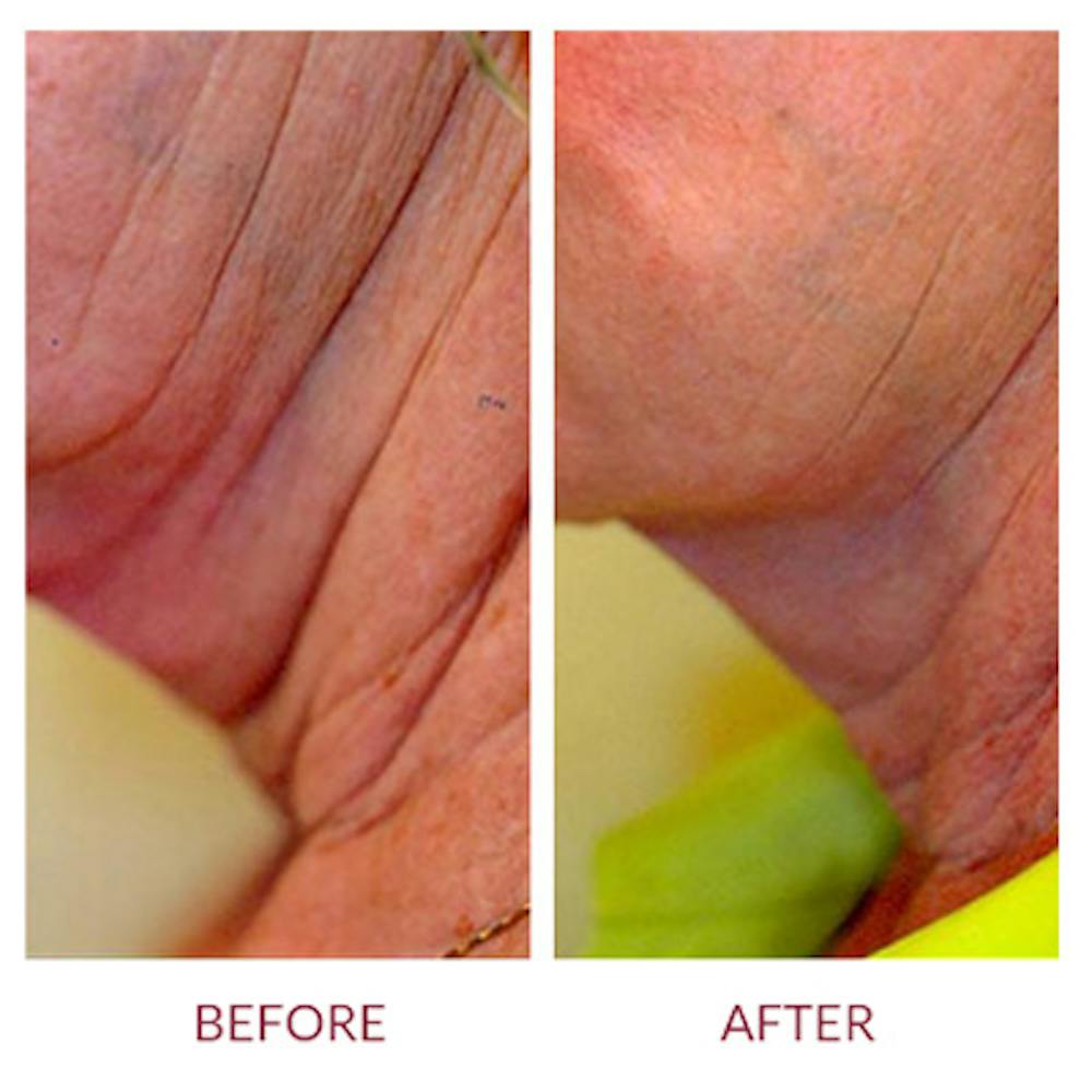 Ultherapy
