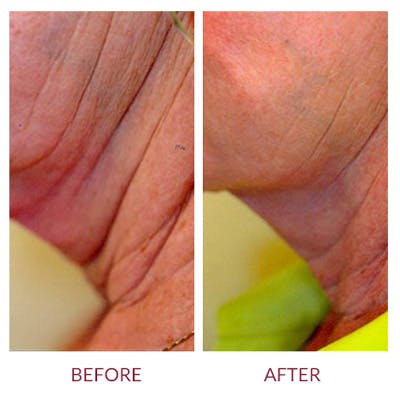 Ultherapy Before & After Gallery - Patient 26874674 - Image 1