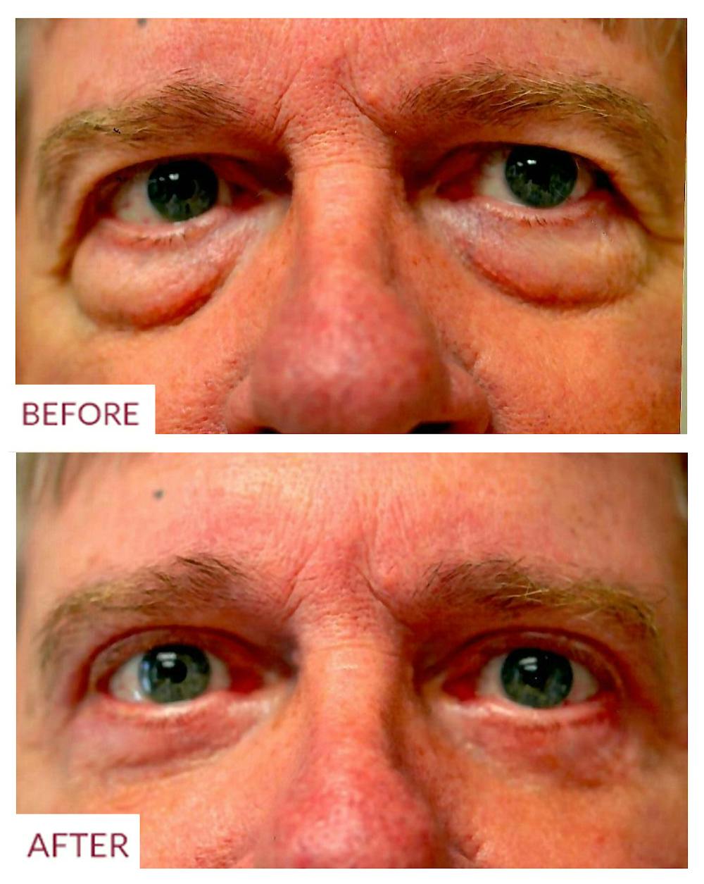 Eyelid Surgery Before & After Gallery - Patient 33369909 - Image 1