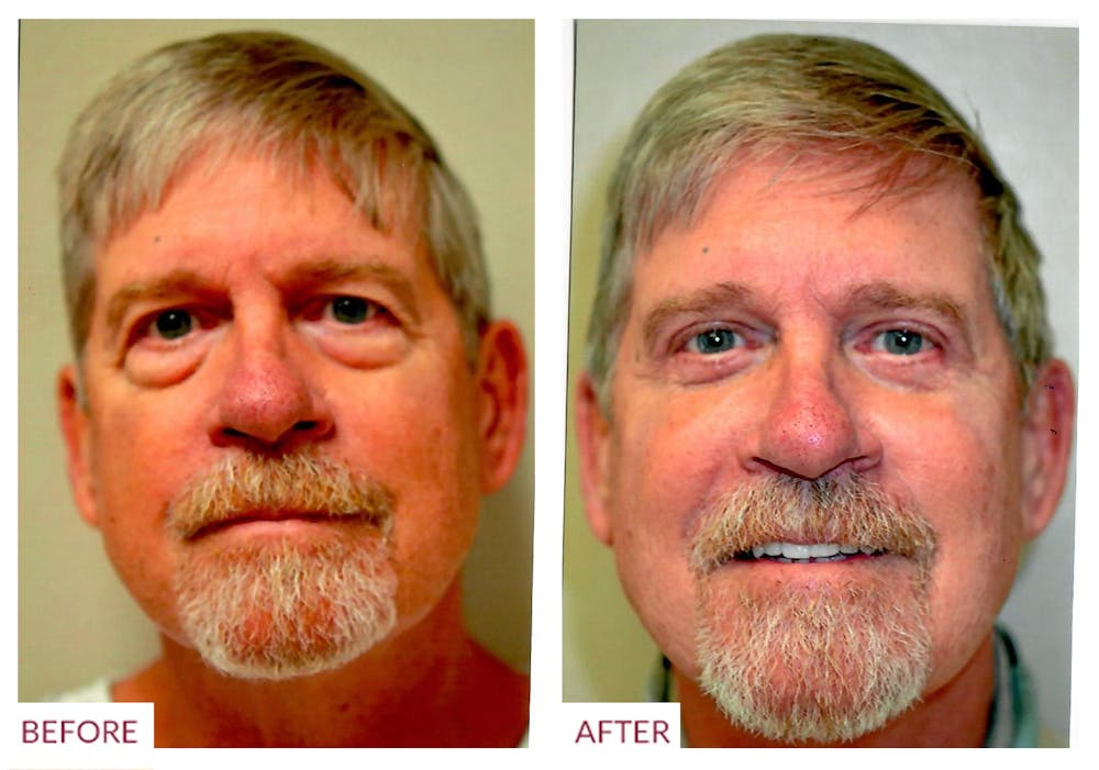 Eyelid Surgery Before & After Gallery - Patient 33369909 - Image 2