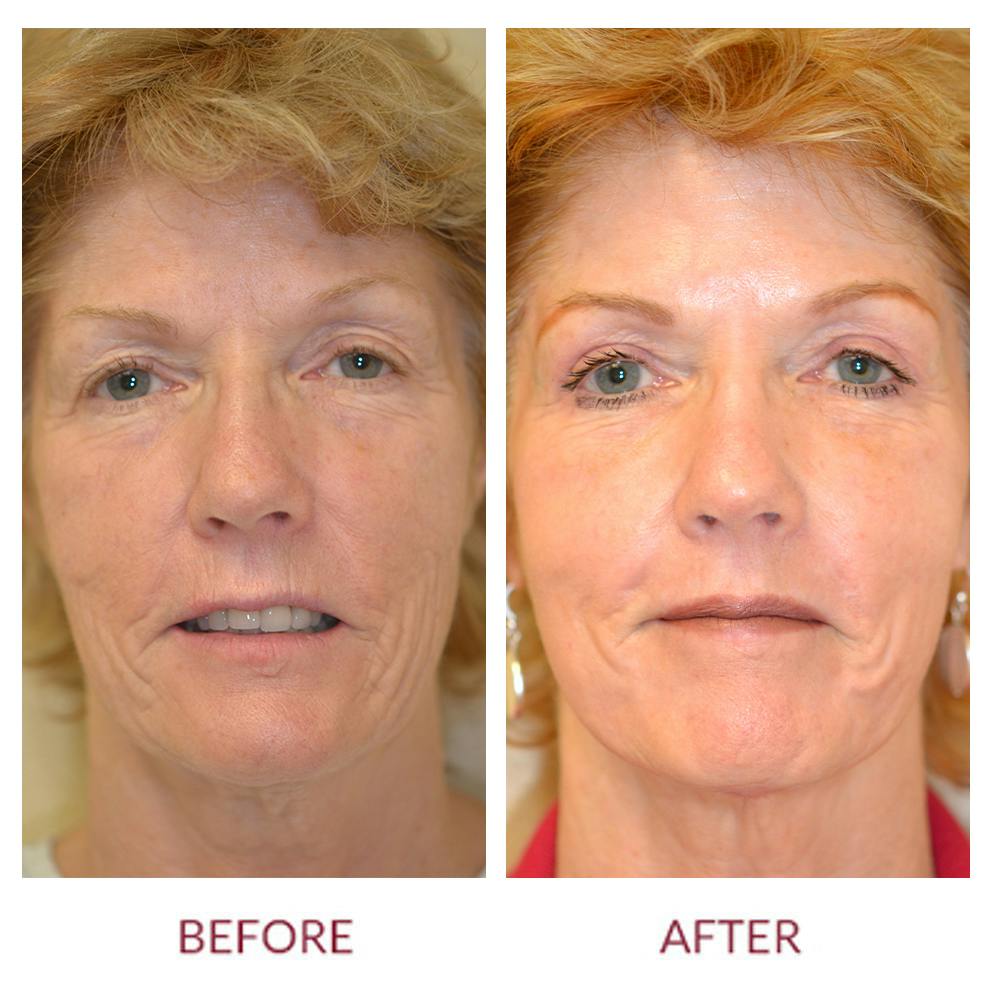 Laser Resurfacing Before & After Gallery - Patient 45453902 - Image 1