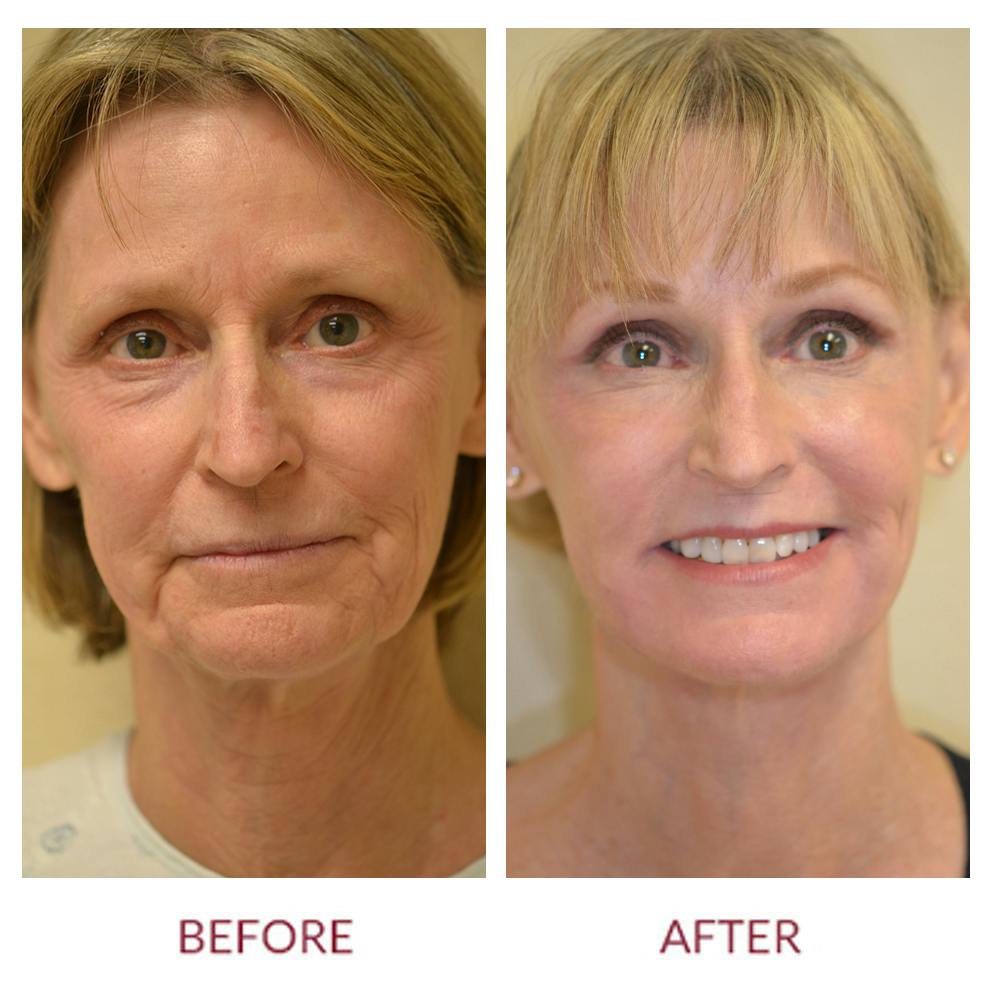 Facelift Before & After Gallery - Patient 45453909 - Image 1