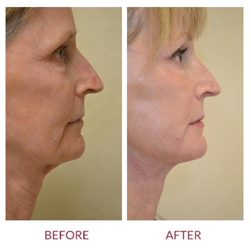 Facelift Before & After Gallery - Patient 45453909 - Image 2