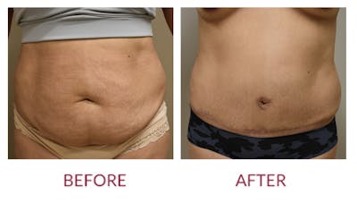 Tummy Tuck Before & After Gallery - Patient 45453914 - Image 1