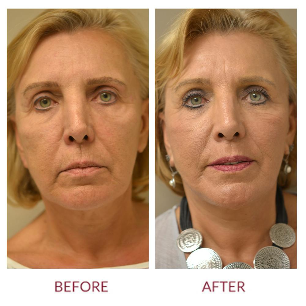 Facelift Before & After Gallery - Patient 45453915 - Image 1