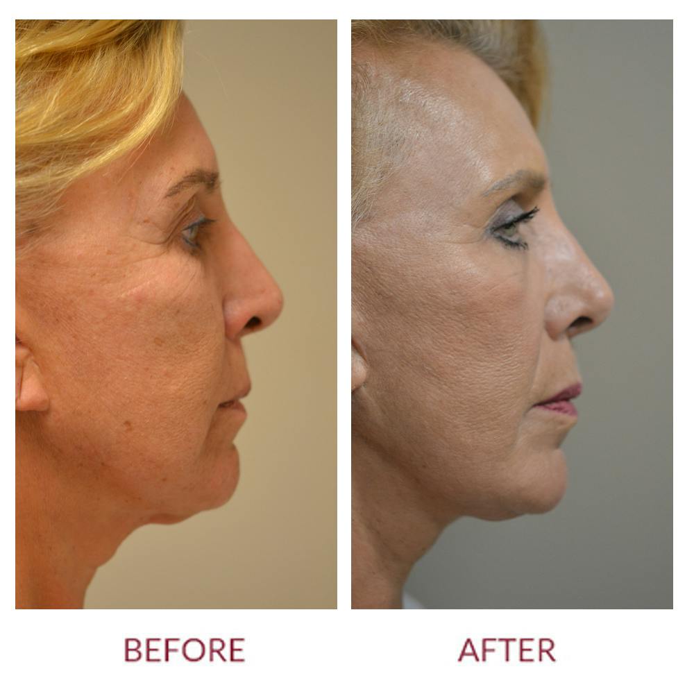 Facelift Before & After Gallery - Patient 45453915 - Image 2