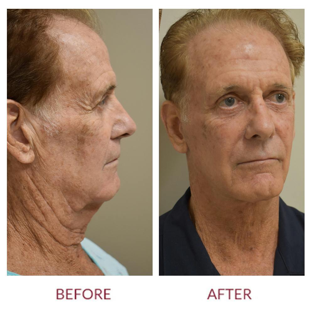 Facelift Before & After Gallery - Patient 45453946 - Image 1