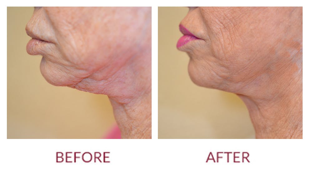 Chin Augmentation Before & After Gallery - Patient 45453949 - Image 1
