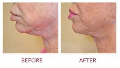 Chin Augmentation Before & After Gallery - Patient 45453949 - Image 1