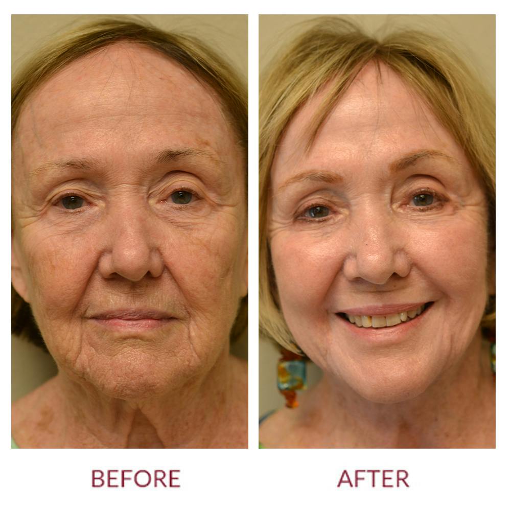 Laser Resurfacing Before & After Gallery - Patient 45454137 - Image 1