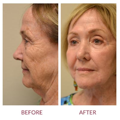 Facelift Before & After Gallery - Patient 45454136 - Image 2