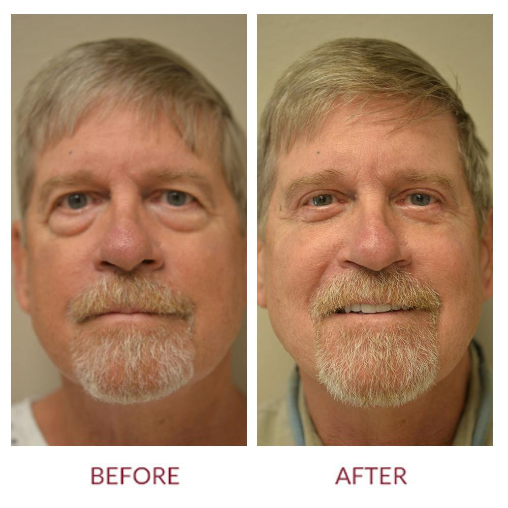 Eyelid Surgery Before & After Gallery - Patient 45454142 - Image 1
