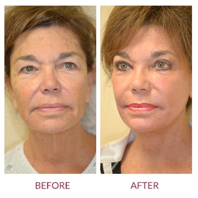 Eyelid Surgery Before & After Gallery - Patient 45454145 - Image 1