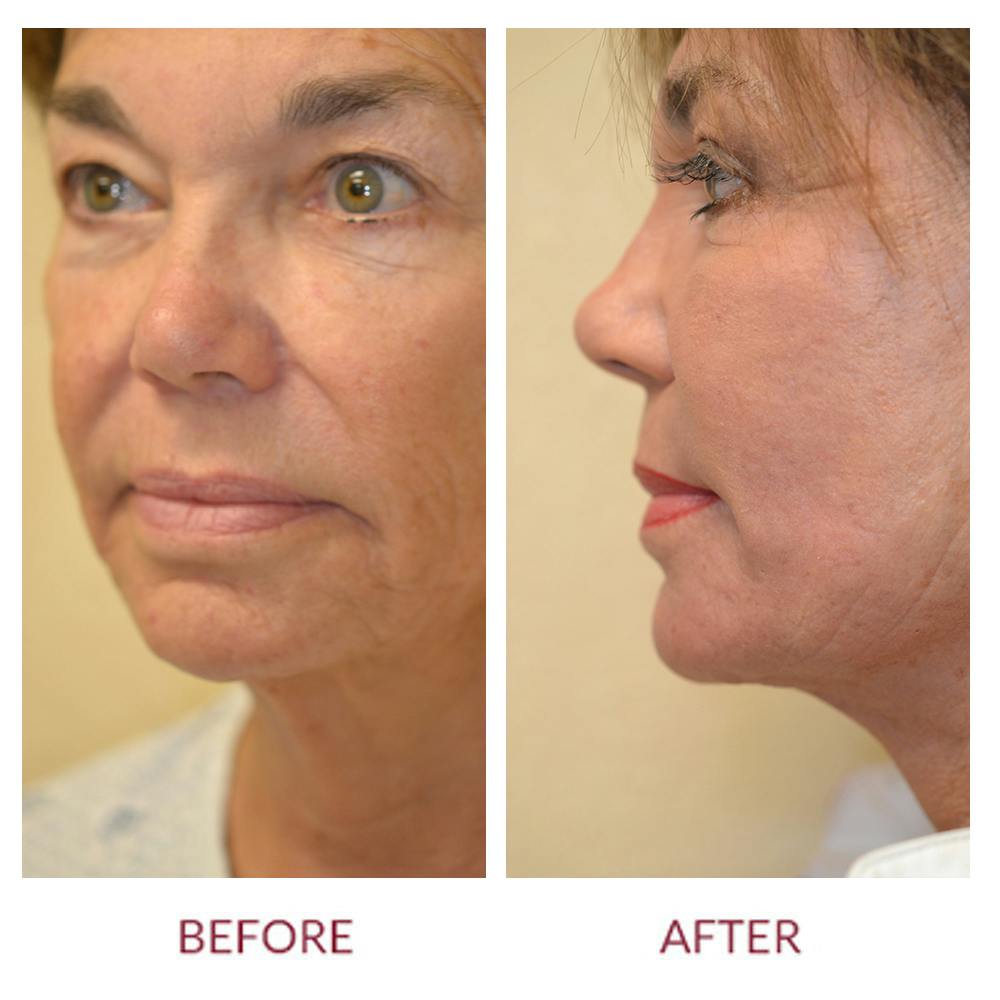 Eyelid Surgery Before & After Gallery - Patient 45454145 - Image 2