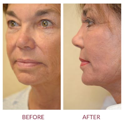 Facelift Before & After Gallery - Patient 45454146 - Image 2