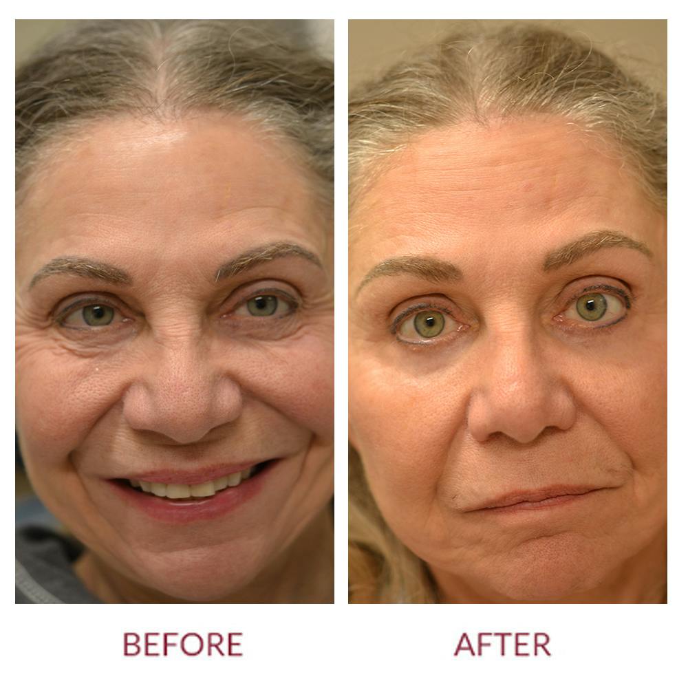 Eyelid Surgery Before & After Gallery - Patient 45454150 - Image 1