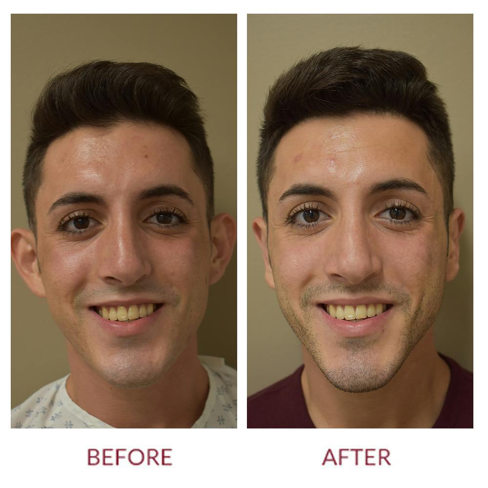 Otoplasty Before & After Gallery - Patient 45457771 - Image 1