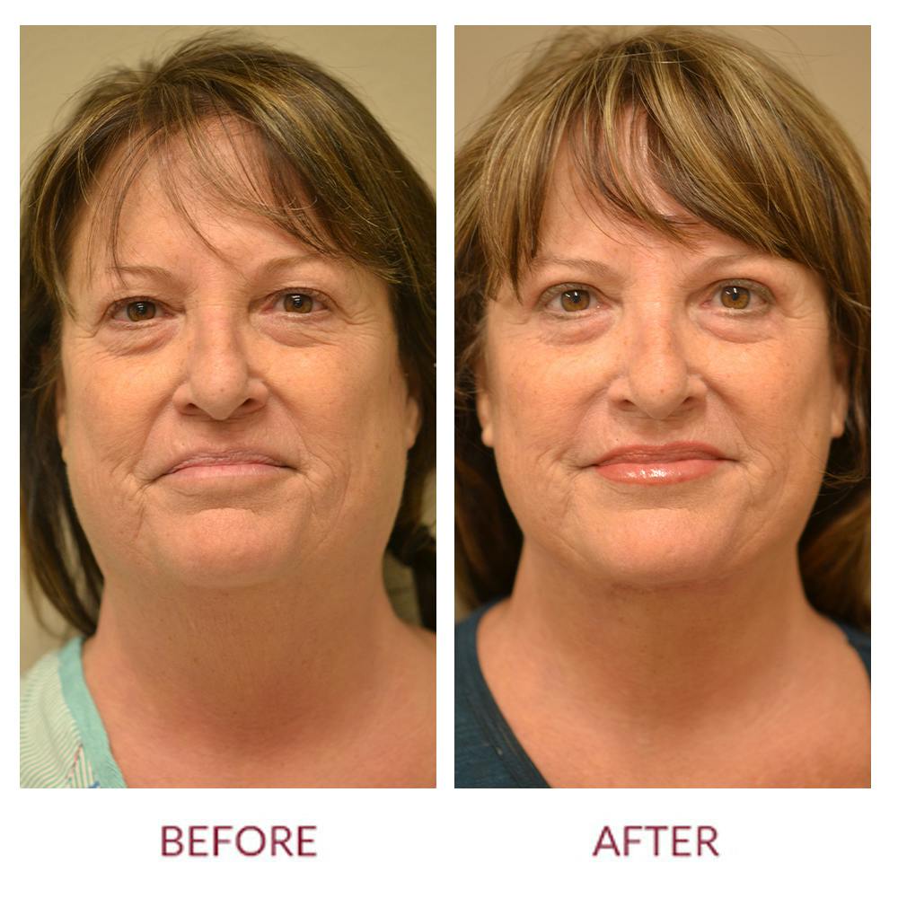 Facelift Before & After Gallery - Patient 46142246 - Image 1