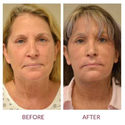 Facelift Before & After Gallery - Patient 46142247 - Image 1