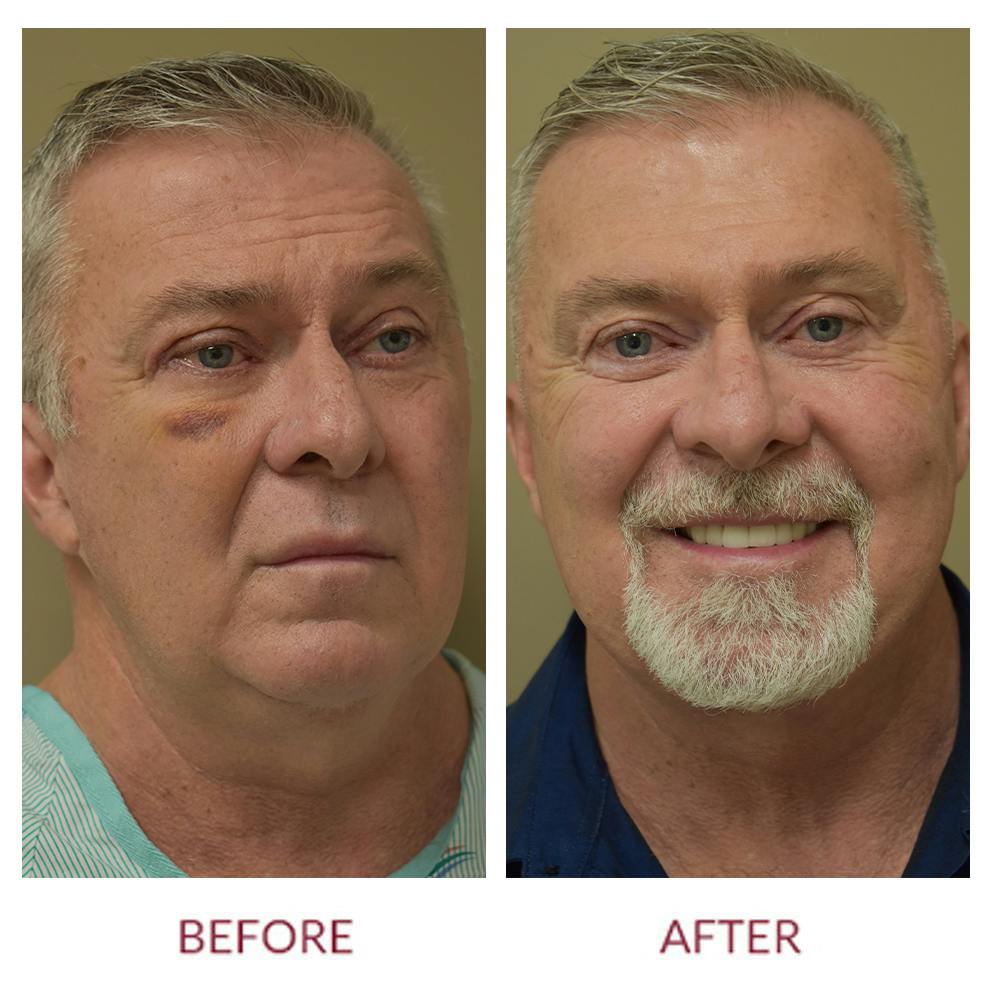 Facelift Before & After Gallery - Patient 46142248 - Image 1