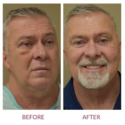 Facelift Before & After Gallery - Patient 46142248 - Image 1