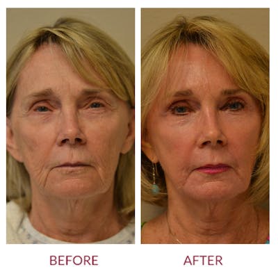 Facelift Before & After Gallery - Patient 46142249 - Image 1