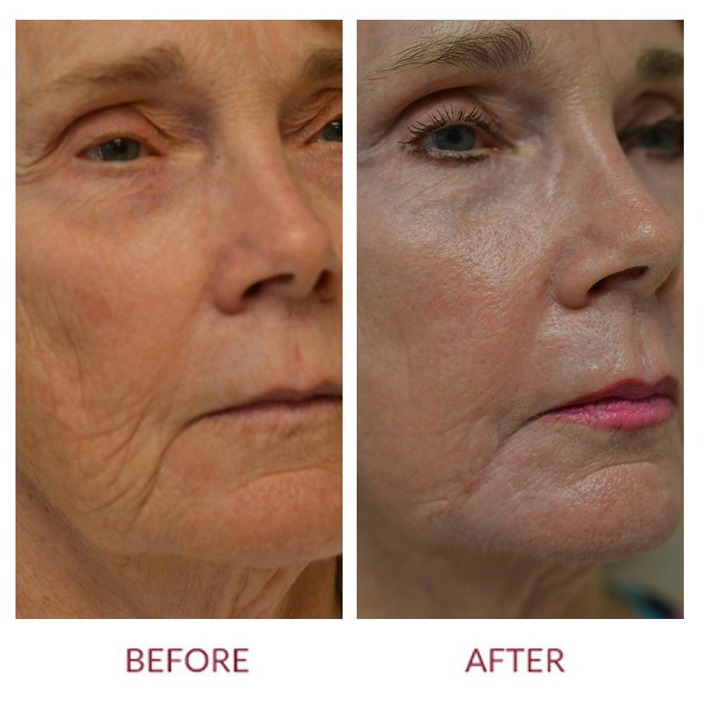 Facelift Before & After Gallery - Patient 46142249 - Image 2