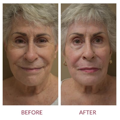 Facelift Before & After Gallery - Patient 46142250 - Image 1