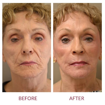 Facelift Before & After Gallery - Patient 46142251 - Image 1