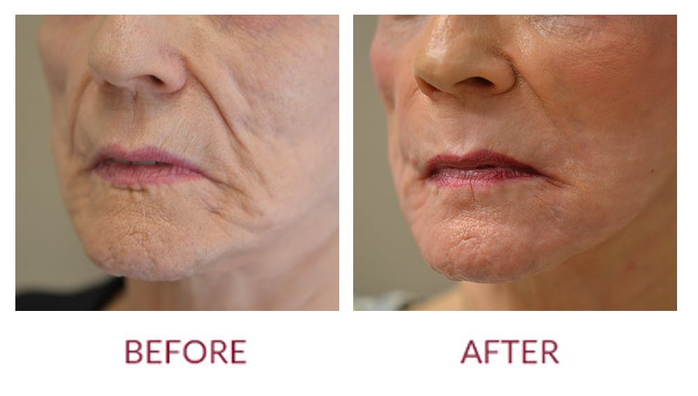 Facelift Before & After Gallery - Patient 46142251 - Image 2