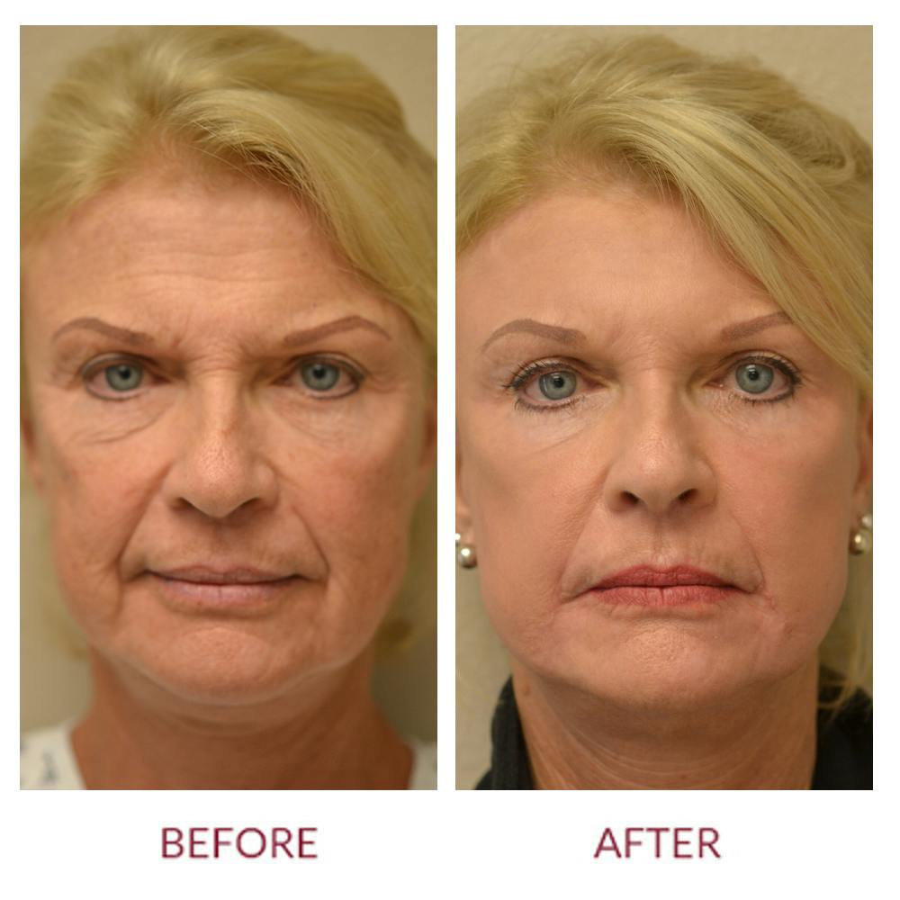 Facelift Before & After Gallery - Patient 46142252 - Image 1