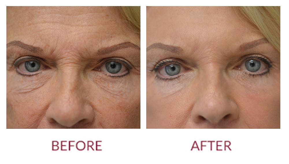Facelift Before & After Gallery - Patient 46142252 - Image 2