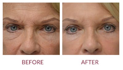 Facelift Before & After Gallery - Patient 46142252 - Image 2