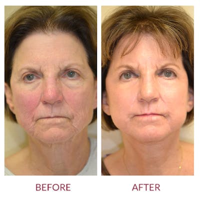 Facelift Before & After Gallery - Patient 46142253 - Image 1