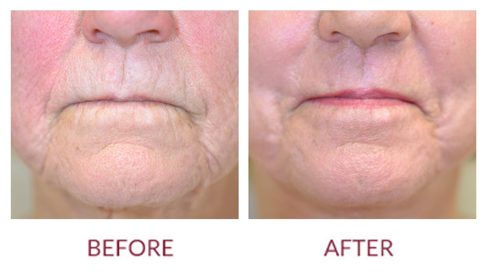 Facelift Before & After Gallery - Patient 46142253 - Image 2