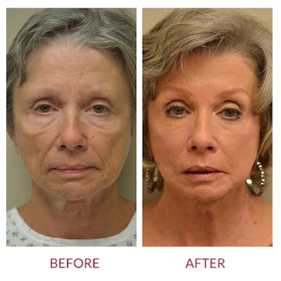 Facelift Before & After Gallery - Patient 46142254 - Image 1