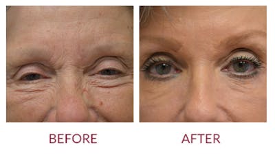 Facelift Before & After Gallery - Patient 46142254 - Image 2