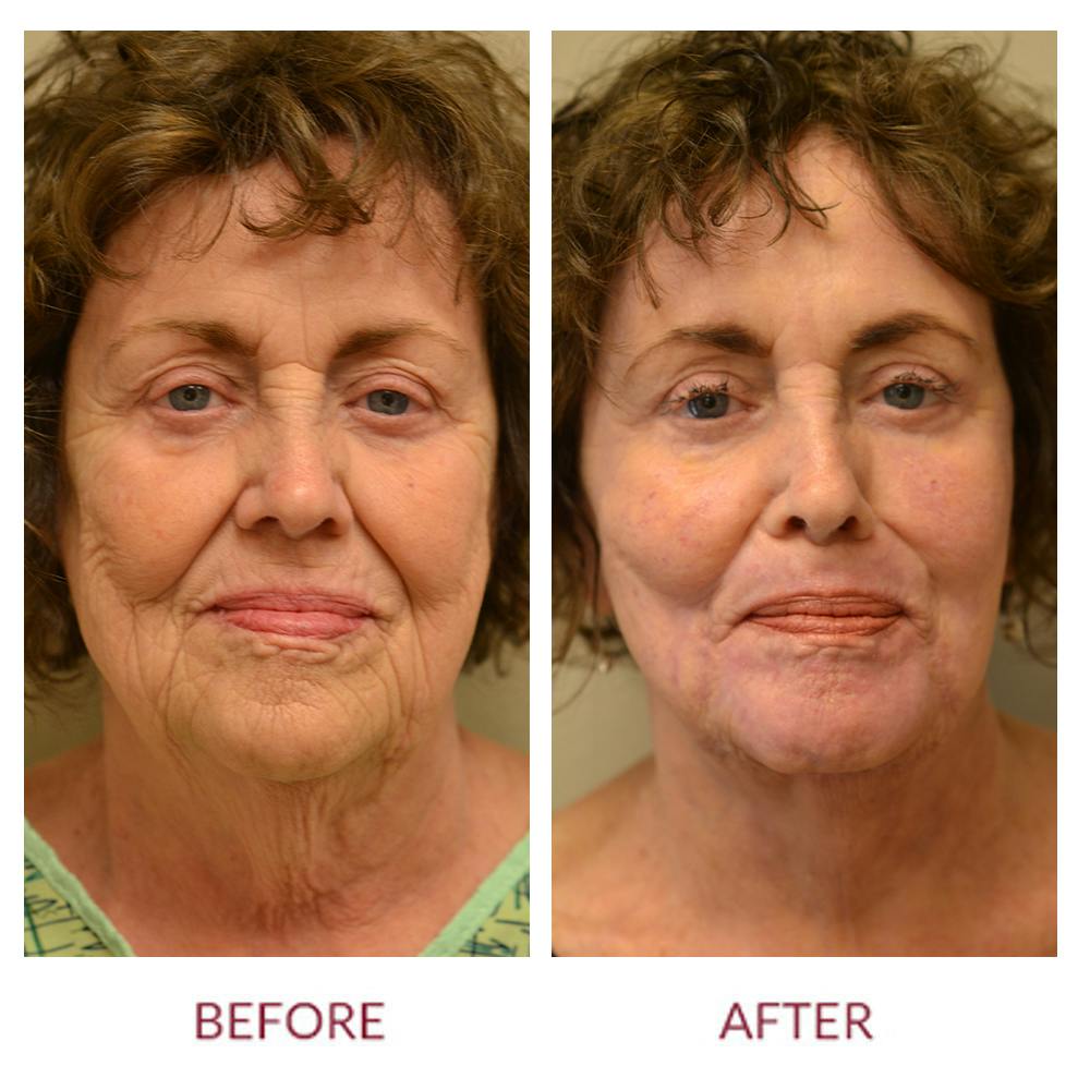Facelift Before & After Gallery - Patient 46142255 - Image 1