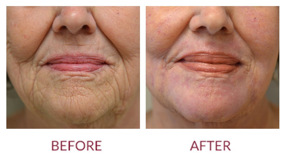 Facelift Before & After Gallery - Patient 46142255 - Image 3