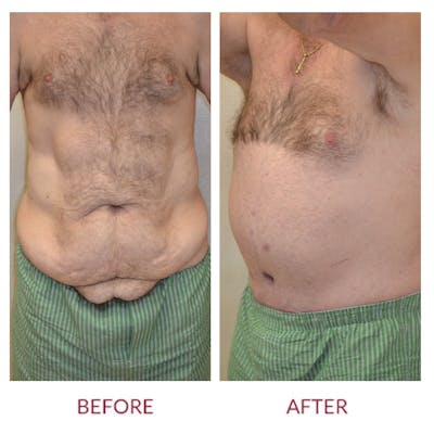 Tummy Tuck Before & After Gallery - Patient 46142296 - Image 1