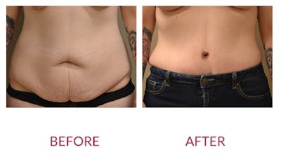 Tummy Tuck Before & After Gallery - Patient 46142297 - Image 1