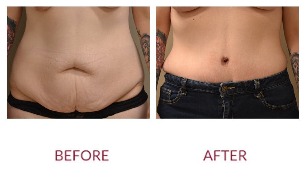 Tummy Tuck Before & After Gallery - Patient 46142297 - Image 1