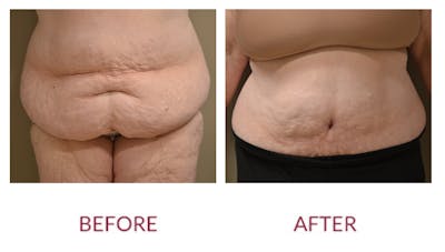 Tummy Tuck Before & After Gallery - Patient 46142298 - Image 1