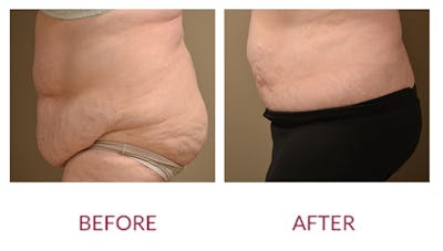 Tummy Tuck Before & After Gallery - Patient 46142298 - Image 2